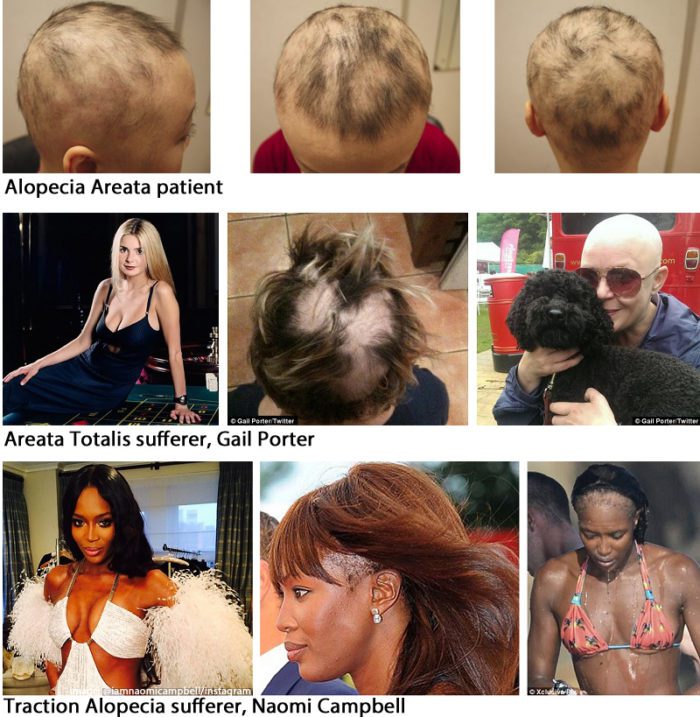 alopecia or hair loss